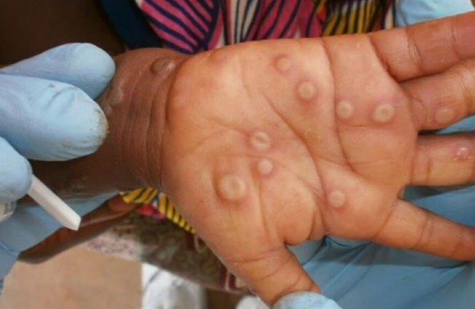 Sağlık Bakanlığı “Maymun Çiçeği Virüsü Rehberi” yayınladı